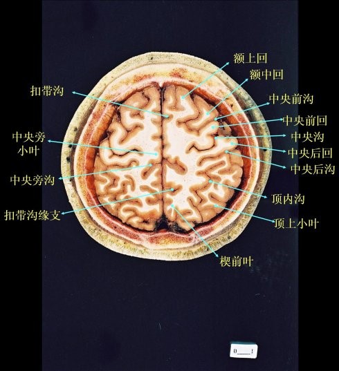 分界标志(三沟五叶"三沟五叶:是指中央沟,外侧沟,顶枕沟;额叶,顶叶