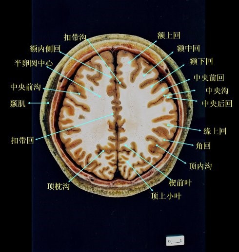 分界标志(三沟五叶"三沟五叶:是指中央沟,外侧沟,顶枕沟;额叶,顶叶