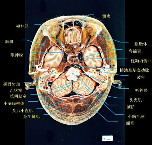 大脑各叶分界标志(三沟五叶)